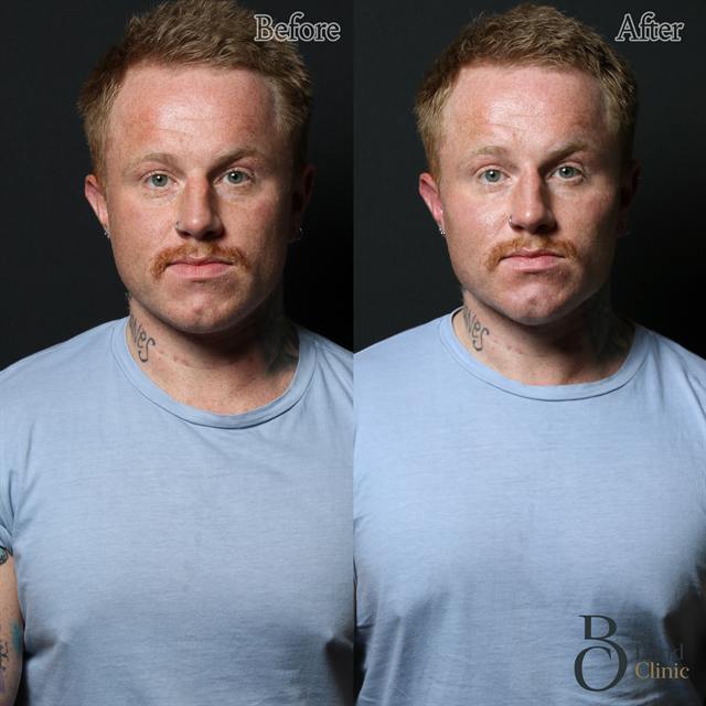 Unretouched before and after result, the drBand Clinic