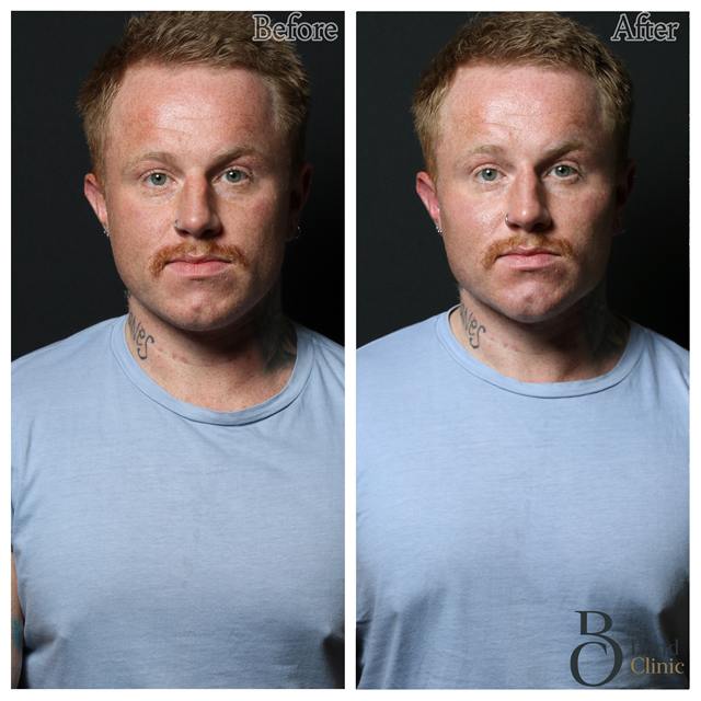Unretouched before and after result, the drBand Clinic