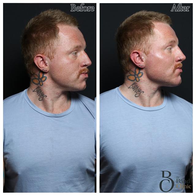 Unretouched before and after result, the drBand Clinic