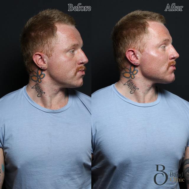 Unretouched before and after result, the drBand Clinic