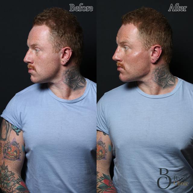 Unretouched before and after result, the drBand Clinic