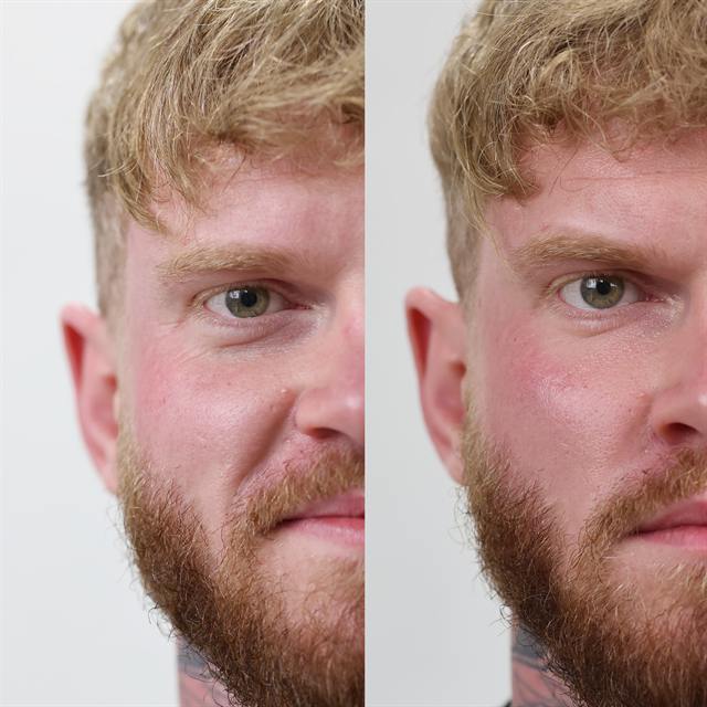 Unretouched before and after result, the drBand Clinic