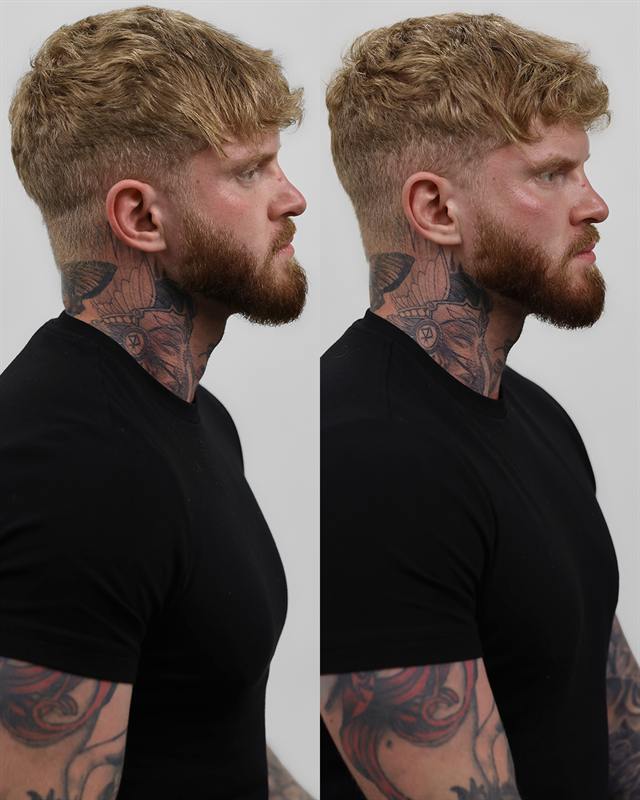 Unretouched before and after result, the drBand Clinic