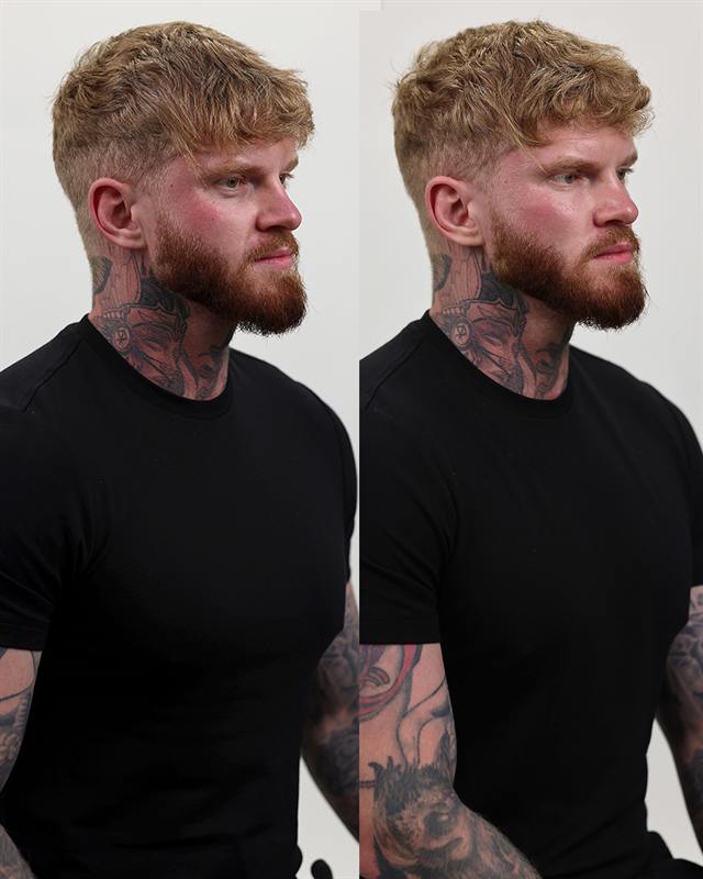 Unretouched before and after result, the drBand Clinic