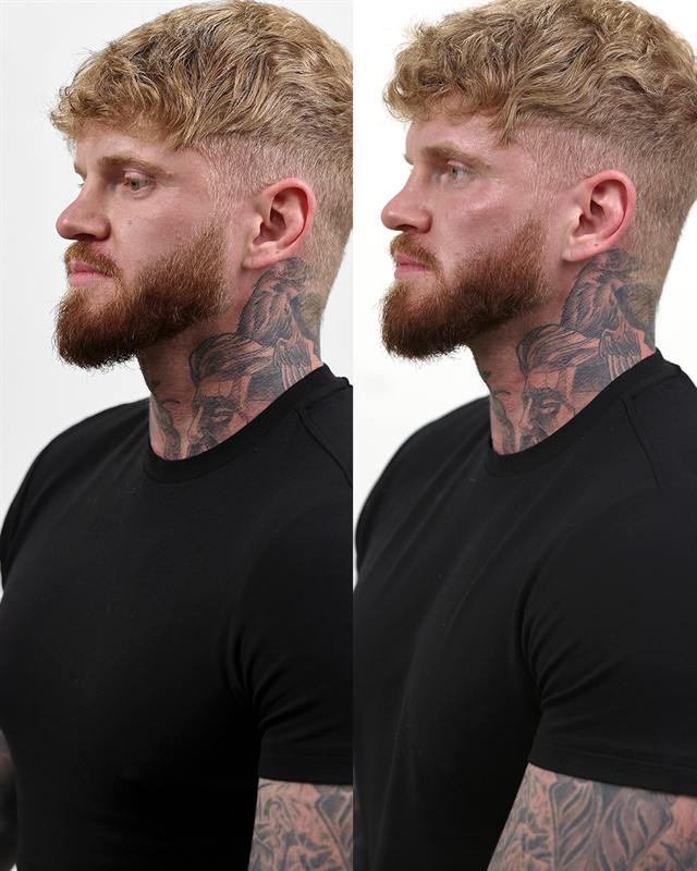 Unretouched before and after result, the drBand Clinic