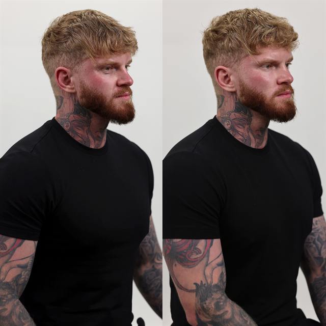 Unretouched before and after result, the drBand Clinic