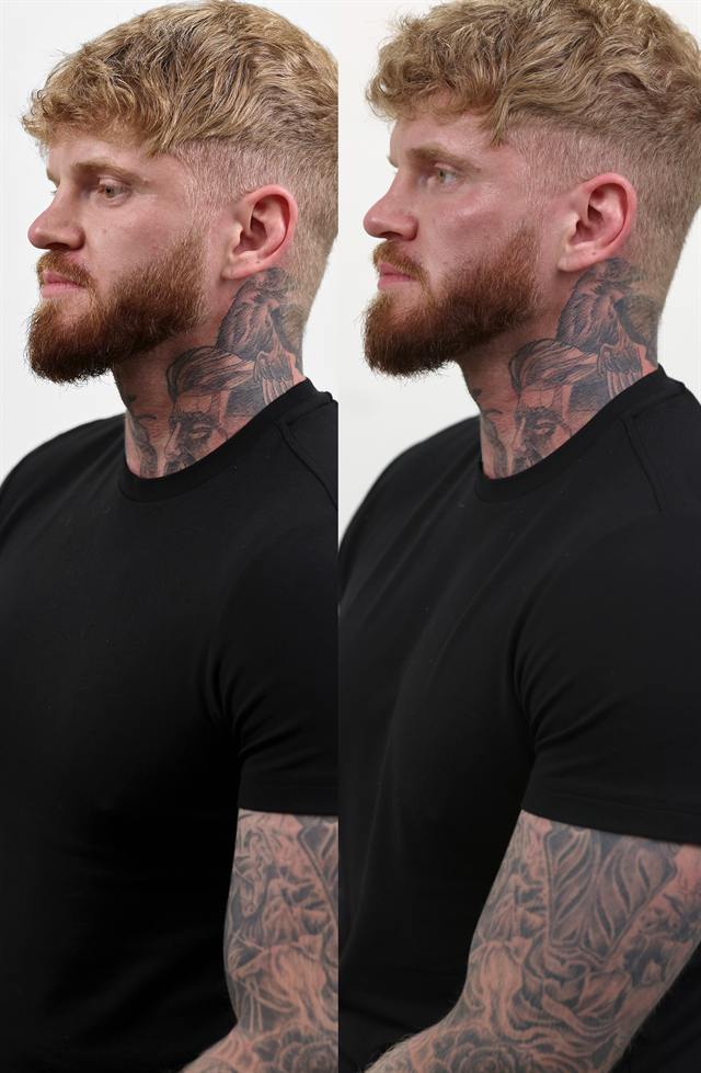 Unretouched before and after result, the drBand Clinic
