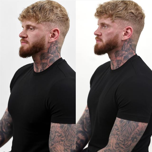 Unretouched before and after result, the drBand Clinic
