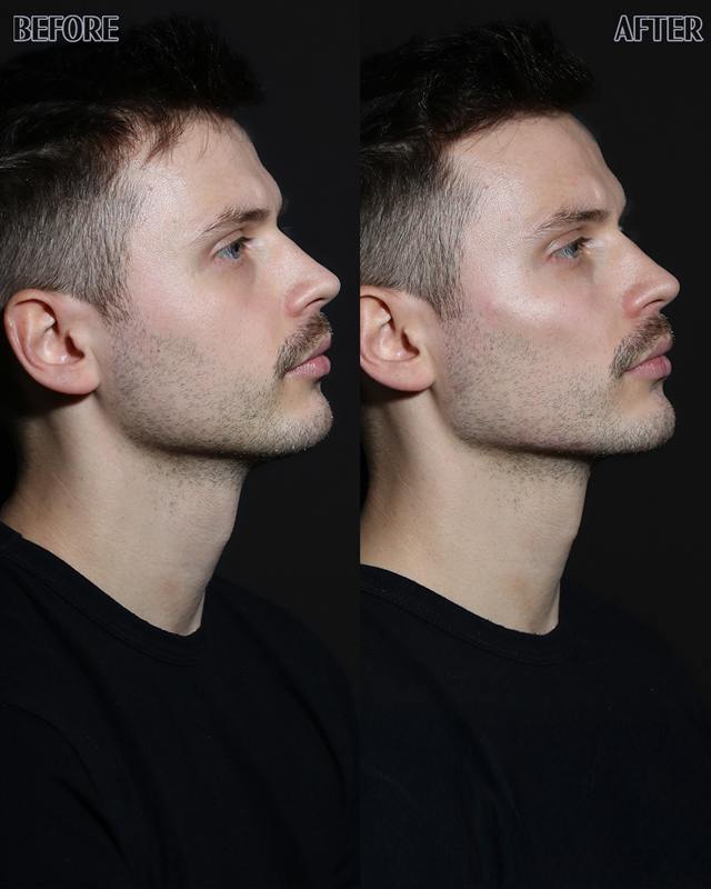 Unretouched before and after result, the drBand Clinic