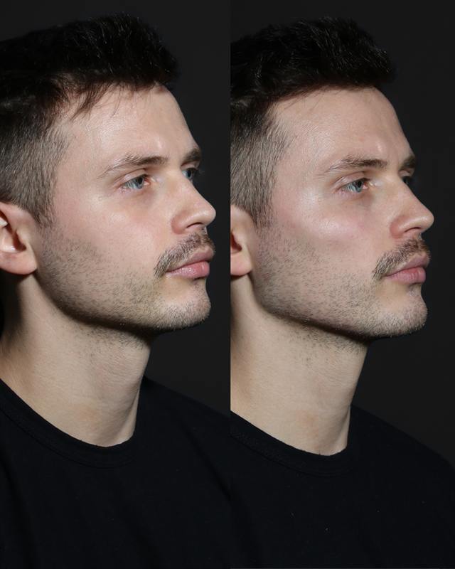 Unretouched before and after result, the drBand Clinic