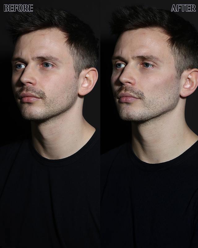 Unretouched before and after result, the drBand Clinic