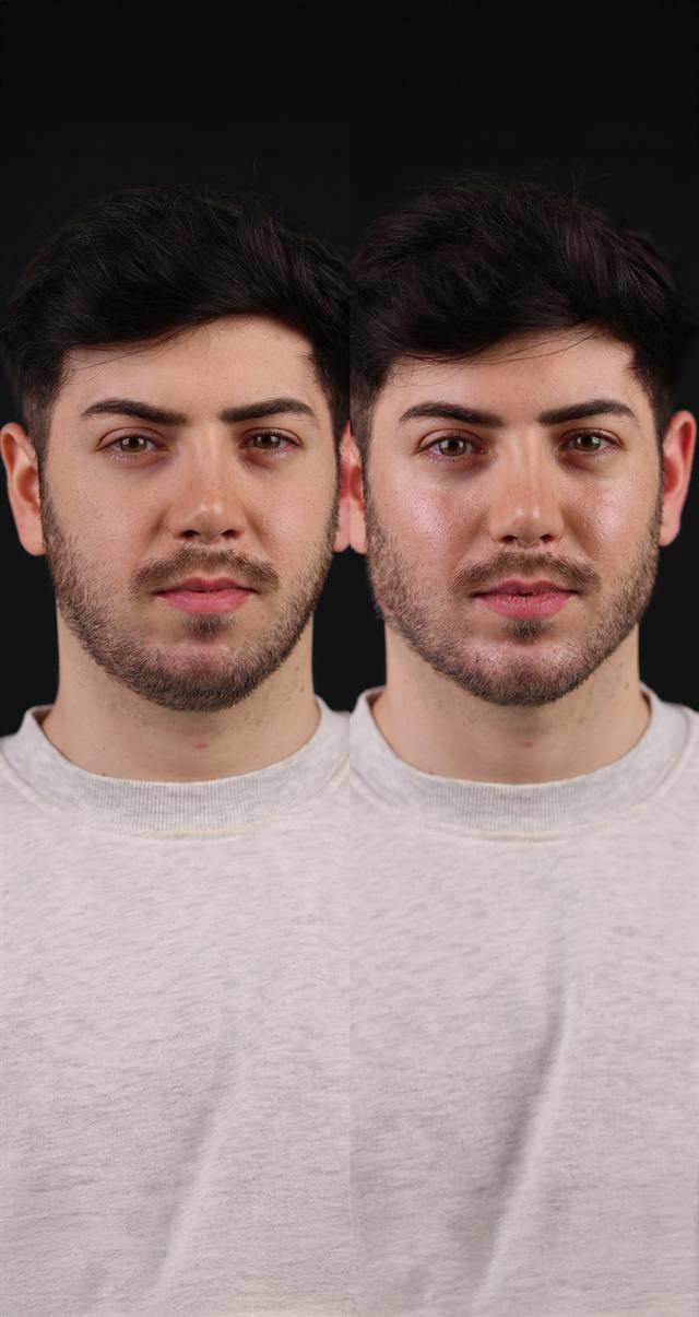 Unretouched before and after result, the drBand Clinic
