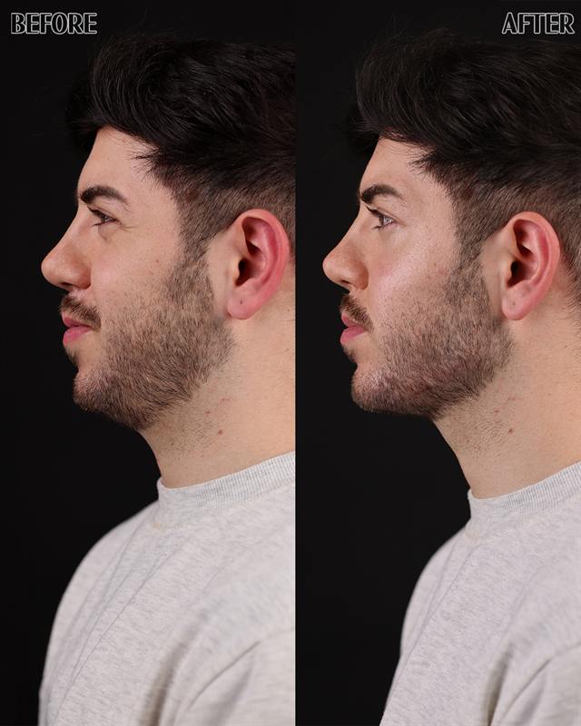 Unretouched before and after result, the drBand Clinic