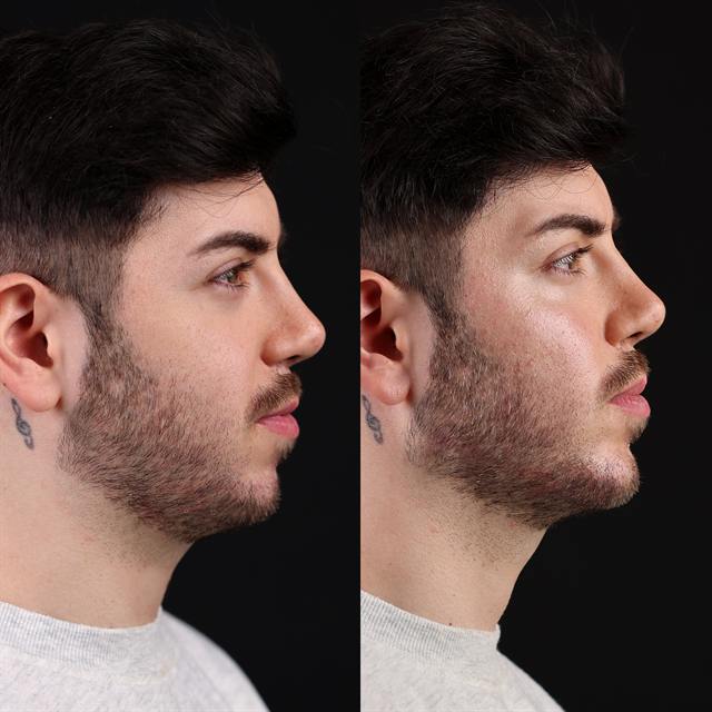 Unretouched before and after result, the drBand Clinic
