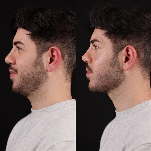 Unretouched before and after result, the drBand Clinic