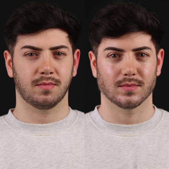 Unretouched before and after result, the drBand Clinic