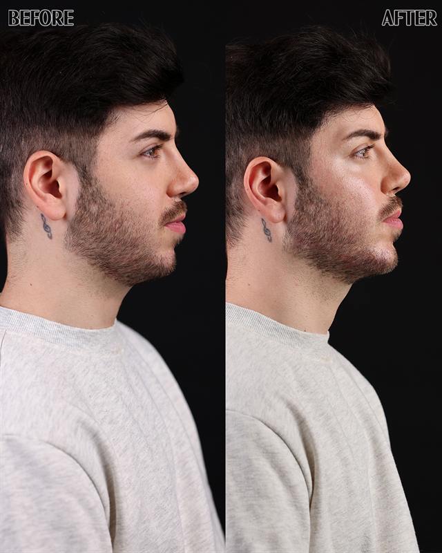 Unretouched before and after result, the drBand Clinic