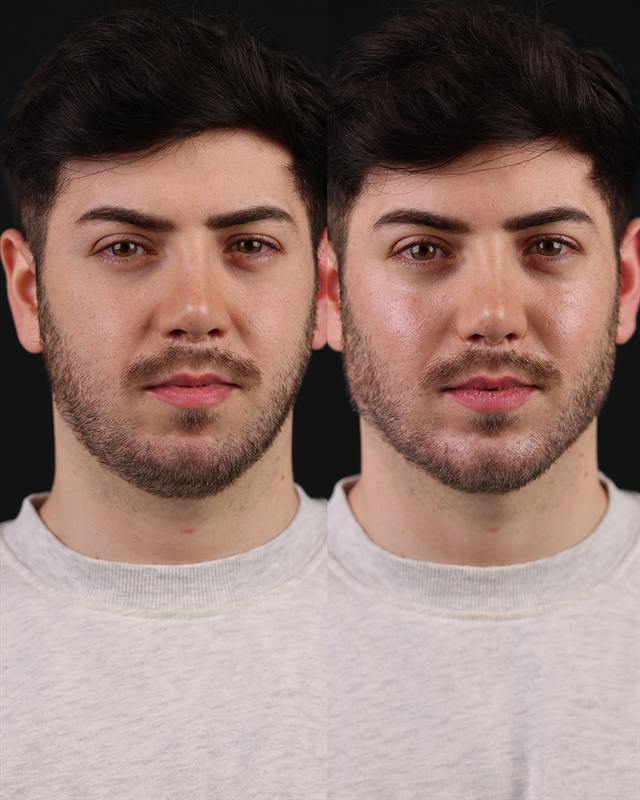 Unretouched before and after result, the drBand Clinic