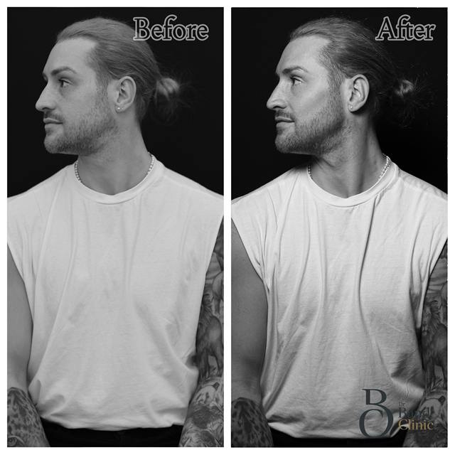Unretouched before and after result, the drBand Clinic
