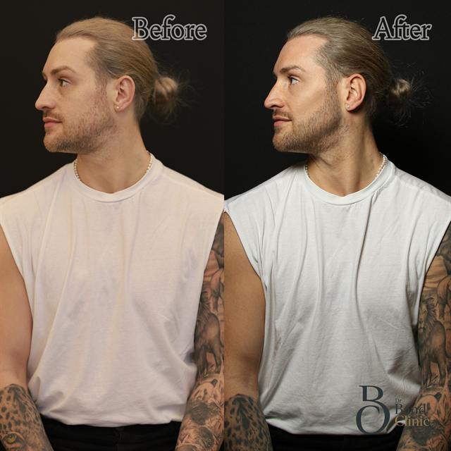 Unretouched before and after result, the drBand Clinic