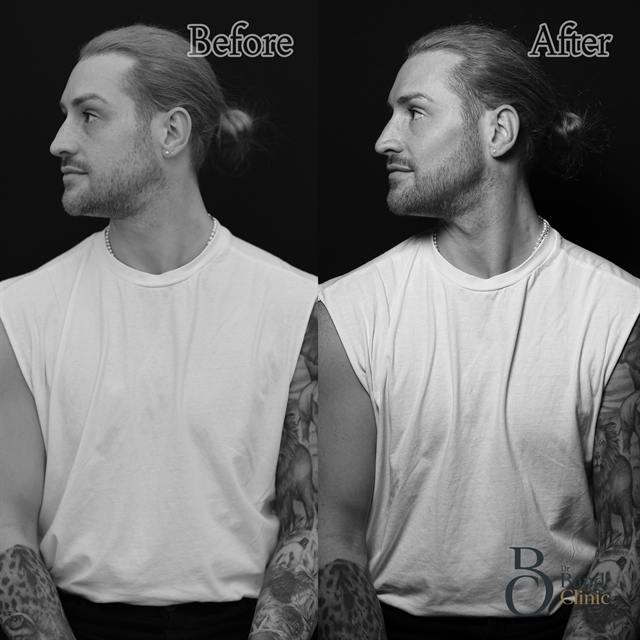 Unretouched before and after result, the drBand Clinic