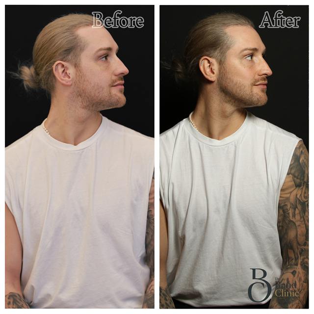 Unretouched before and after result, the drBand Clinic