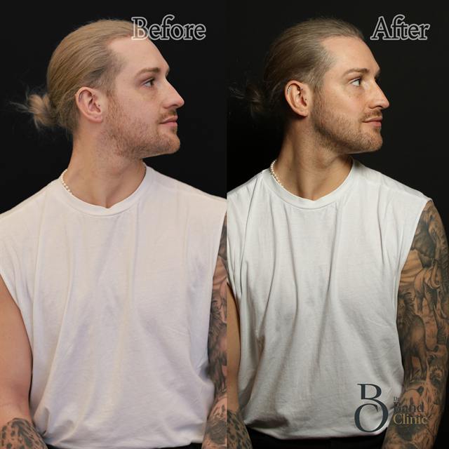 Unretouched before and after result, the drBand Clinic