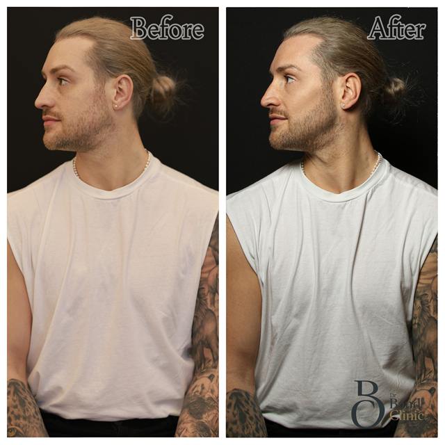 Unretouched before and after result, the drBand Clinic