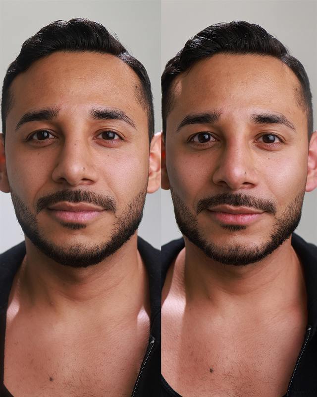 Unretouched before and after result, the drBand Clinic