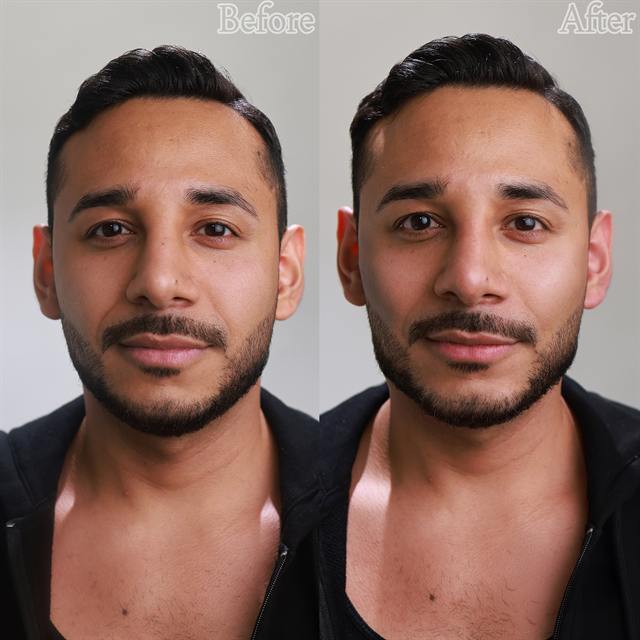Unretouched before and after result, the drBand Clinic