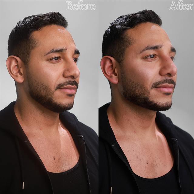 Unretouched before and after result, the drBand Clinic