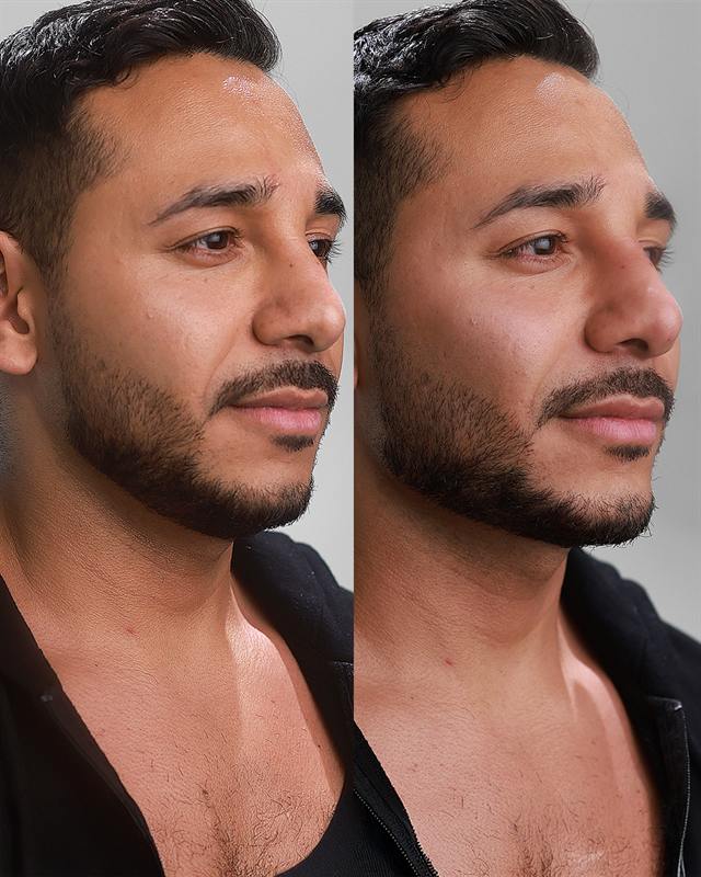 Unretouched before and after result, the drBand Clinic