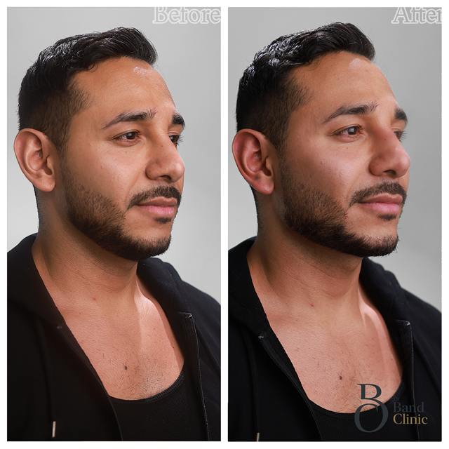 Unretouched before and after result, the drBand Clinic