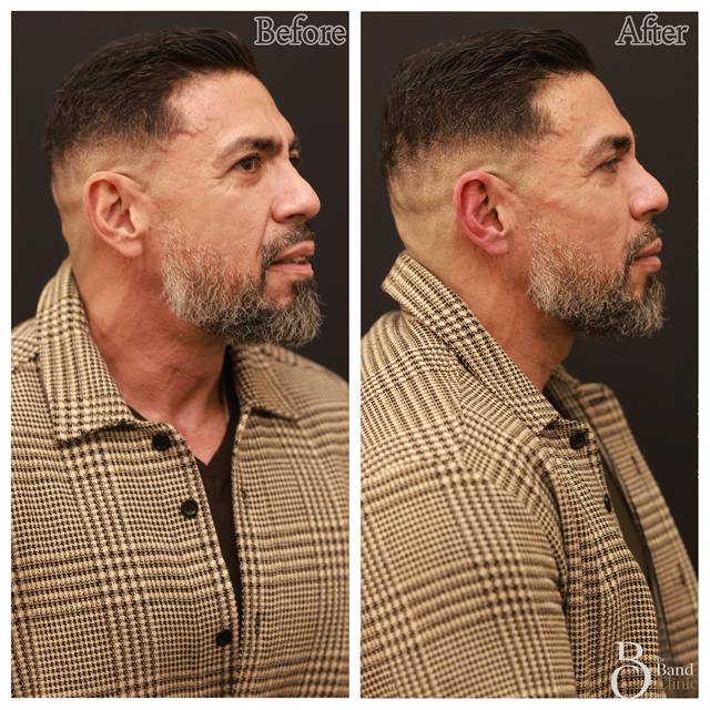 Unretouched before and after result, the drBand Clinic