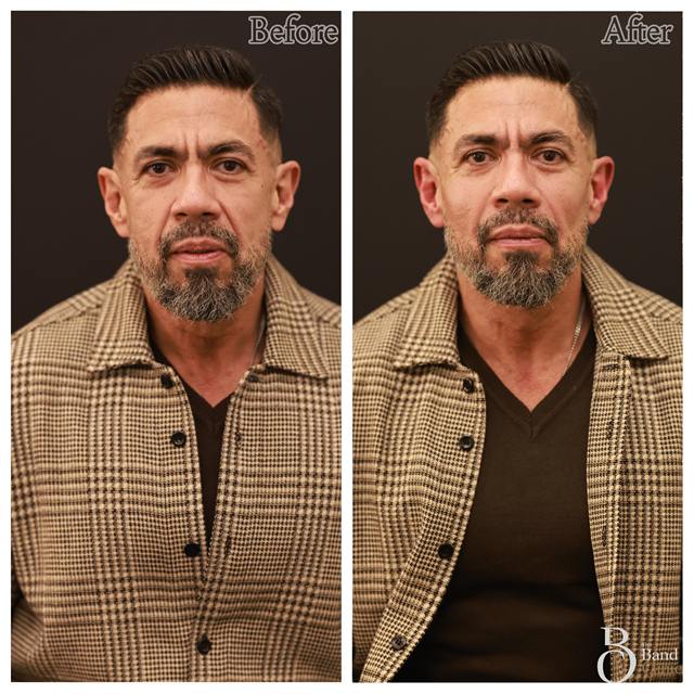 Unretouched before and after result, the drBand Clinic