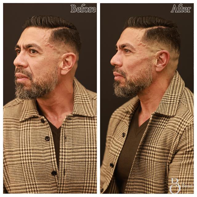 Unretouched before and after result, the drBand Clinic