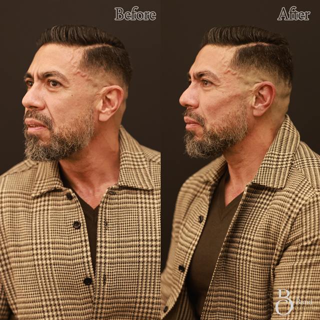 Unretouched before and after result, the drBand Clinic