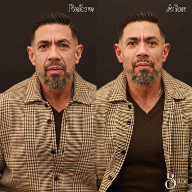 Unretouched before and after result, the drBand Clinic