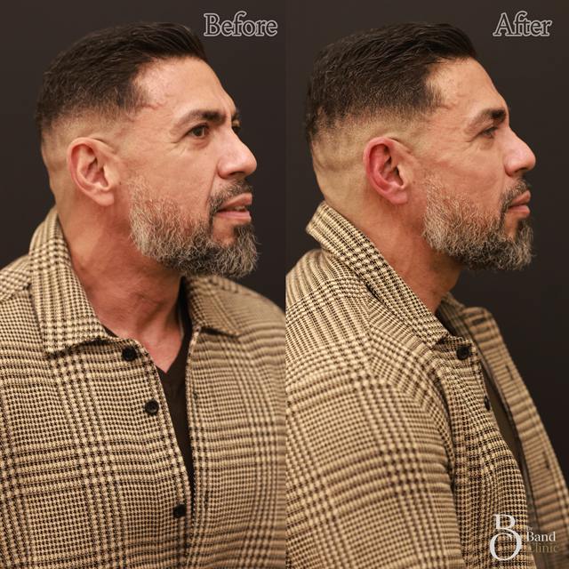 Unretouched before and after result, the drBand Clinic