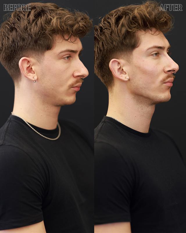 Unretouched before and after result, the drBand Clinic