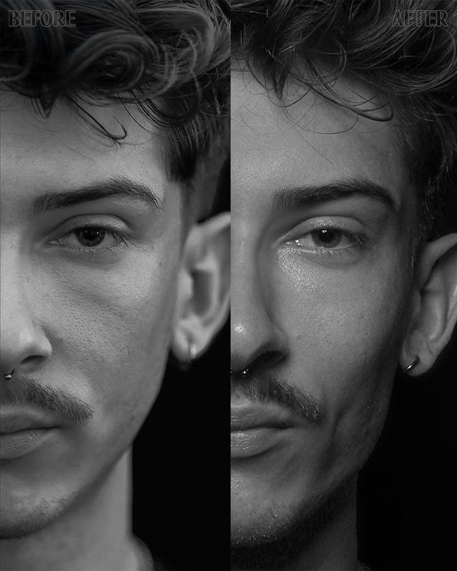 Unretouched before and after result, the drBand Clinic