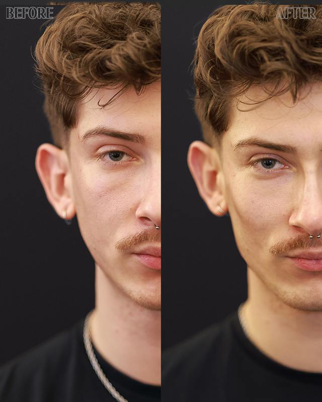 Unretouched before and after result, the drBand Clinic