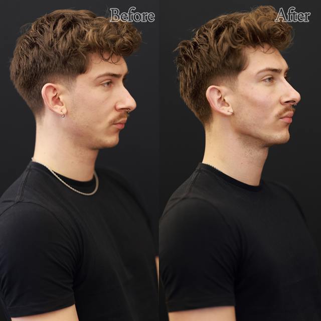 Unretouched before and after result, the drBand Clinic