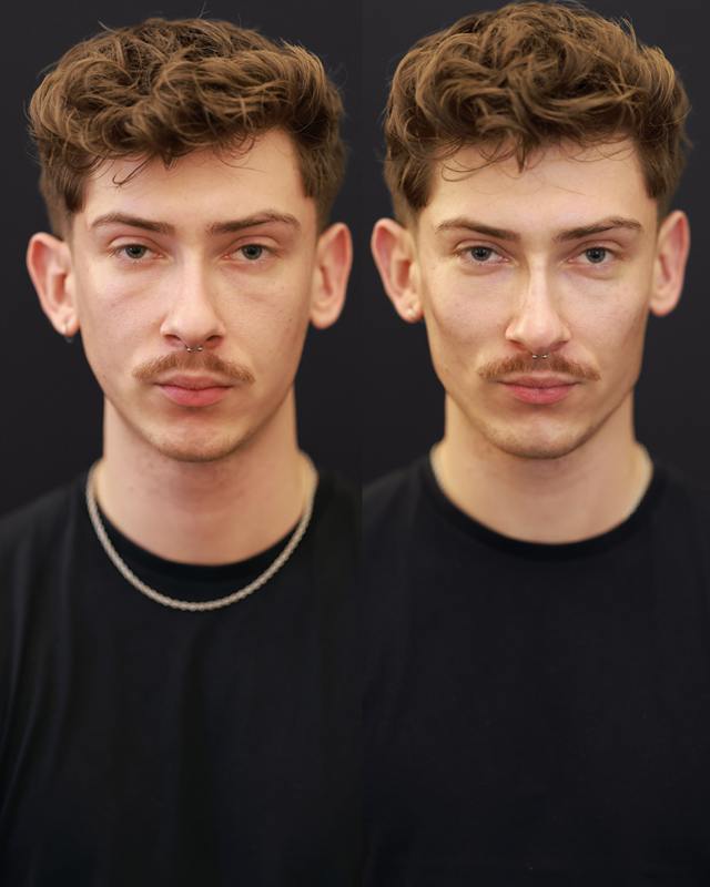 Unretouched before and after result, the drBand Clinic