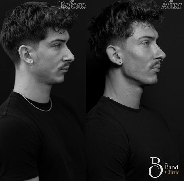 Unretouched before and after result, the drBand Clinic