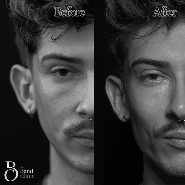 Unretouched before and after result, the drBand Clinic