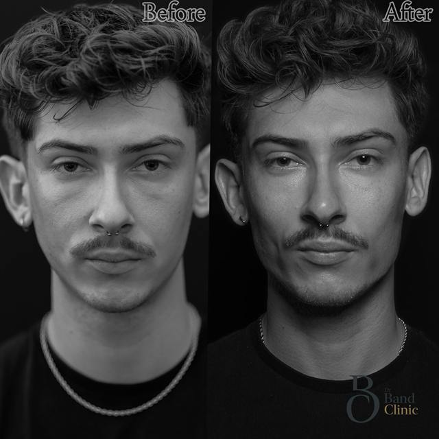 Unretouched before and after result, the drBand Clinic