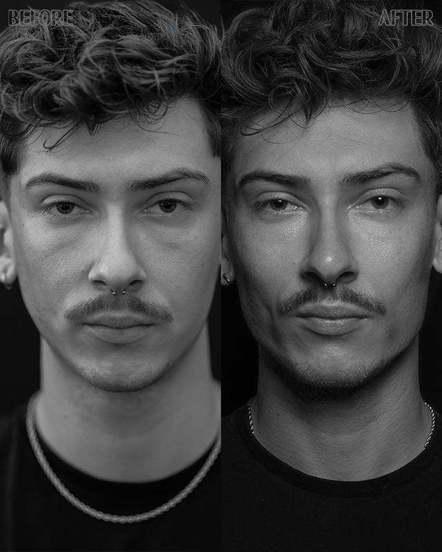 Unretouched before and after result, the drBand Clinic