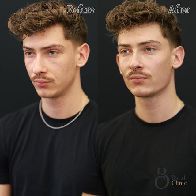 Unretouched before and after result, the drBand Clinic