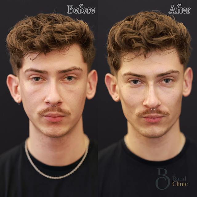 Unretouched before and after result, the drBand Clinic